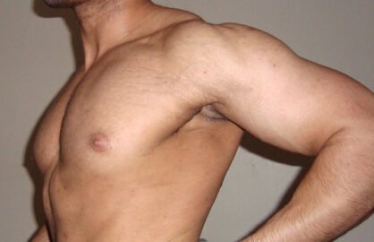 Rạn da khi tập gym là gì ? 13