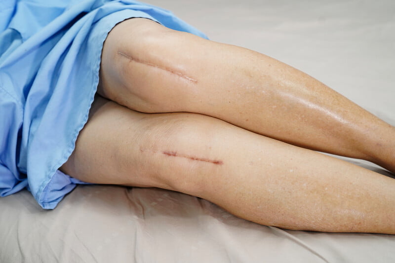 Cách Phục Hồi Chức Năng Khớp Gối Sau Phẫu Thuật 1